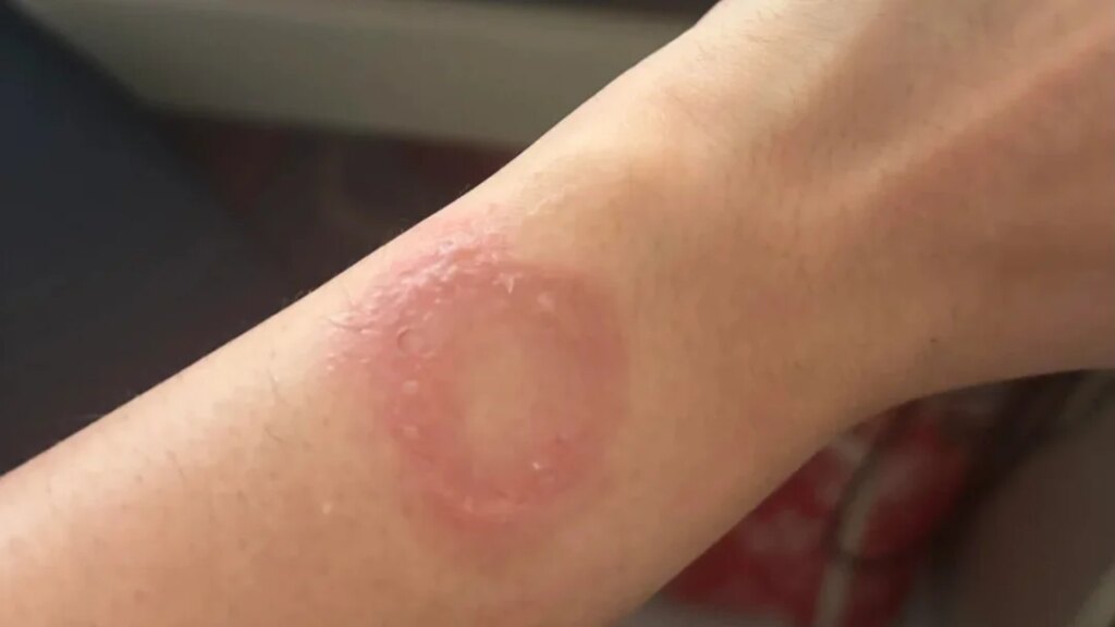 apple watch burned my wrist and left a scar ive been v0 ikde9qdw71pg1.jpg